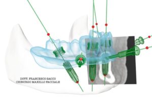 Implantologia Dentaria Salerno Dr. Francesco Sacco
